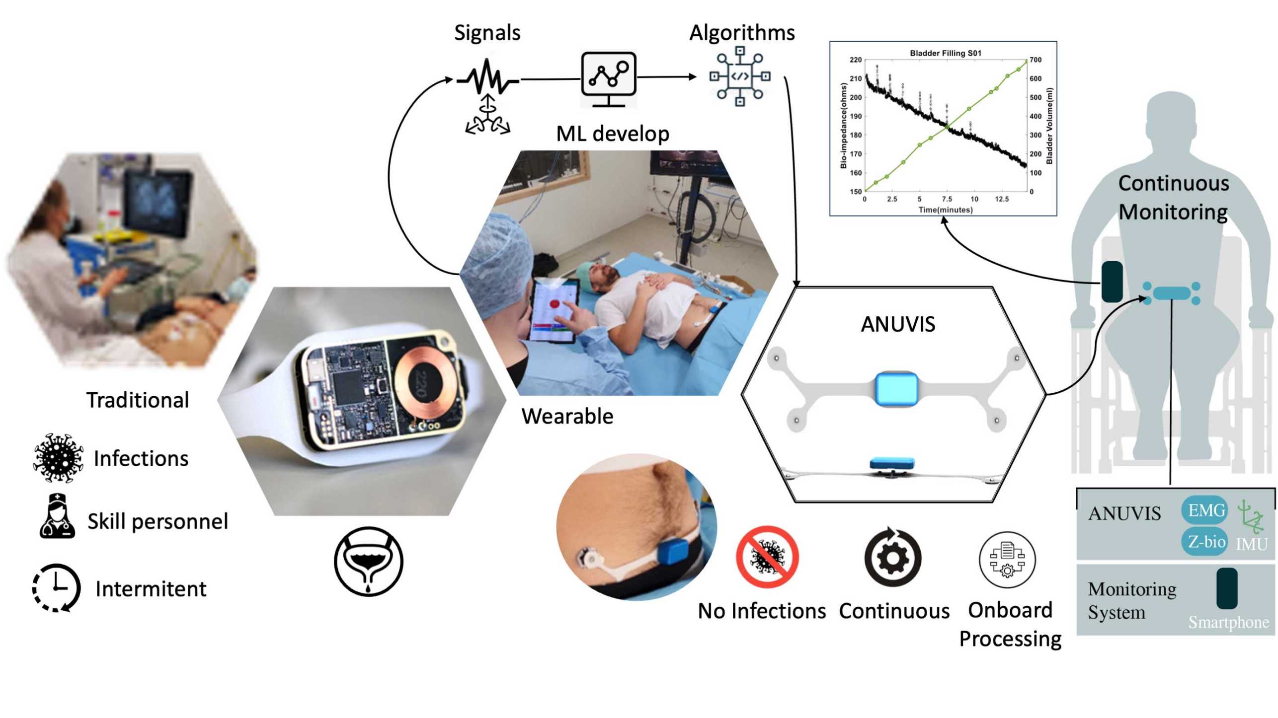 Enlarged view: Continuous sensing of wheelchair user’s bladder function